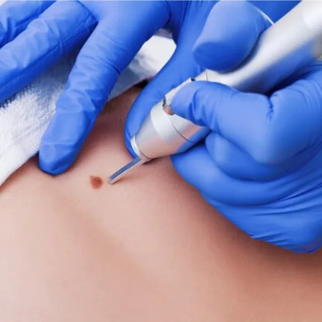 Фото услуги: Удаление папиллом